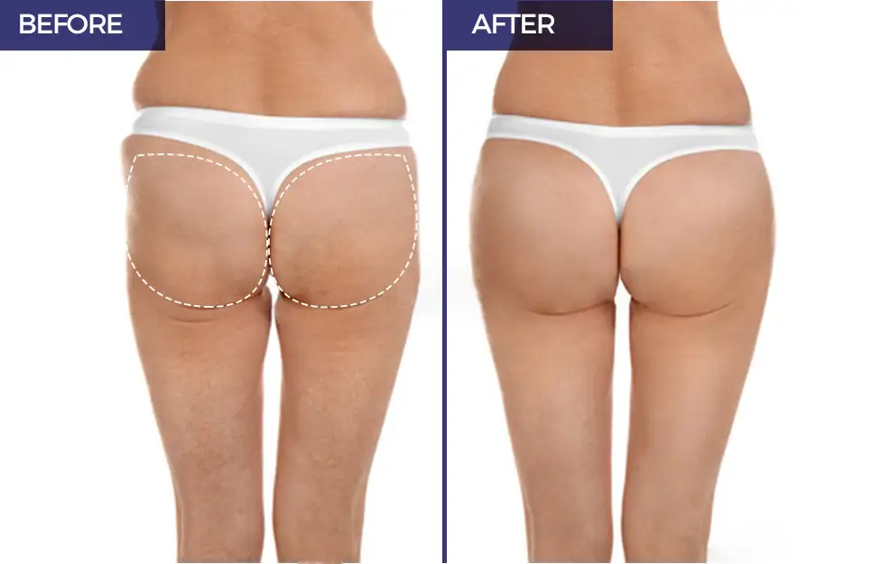 Liposuction + buttlift.jpg